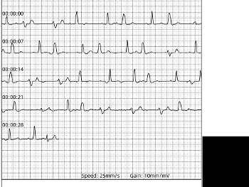 Contec PM20 ECG showing multiple ectopic beats