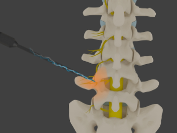 Radiofrequency Ablation for Back Pain