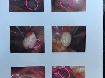 Endo Surgery