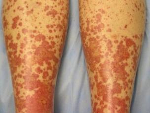 Image of purpura in undamaged skin caused by autoimmune vasculitis. 