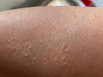 Patches of goosebumps on arm