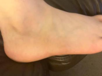 bruise on ankle