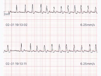 Ectopic rhythm & AF trace from Wellue ECG device.