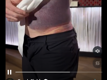 Bruise on famous chef 
