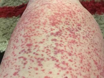 Right less covered in angry red spots which is HS Purpura 