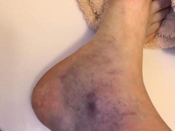 Bruise on ankle
