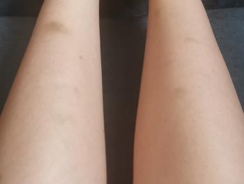 Picture of legs with bruises 