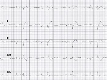 Here is an example of my ECG yesterday.  Actual hb not near as stated.