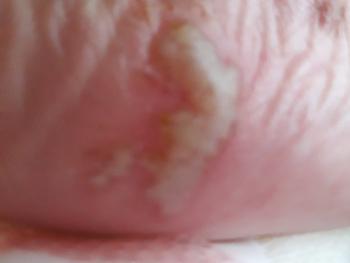 Inflammed blister on sole of foot