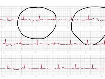 This ecg was taken also when not feeling right with heart beat 