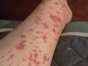 my legs after small vessel vasculitis...