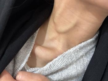 Right side of my neck , external jugular vein 