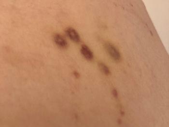 Photo of skin marks.