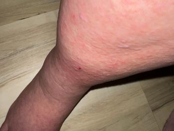Intermittent body rash from , most likely , ADT
