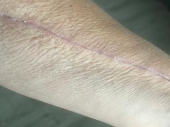 Arm scar, 4 weeks