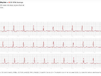 Apple ECG NSR after fast AF.