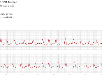 Apple Watch ECG trace showing AF.