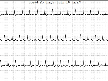 Atrial Flutter diagnosed by ER in February.  HR 150 bpm for 7 hours.