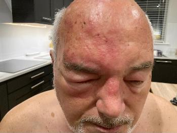 Facial shingles. I thought he’d been in a car accident when he sent me this photo!