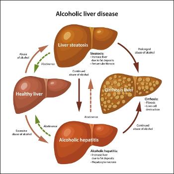 Liver disease progression image.