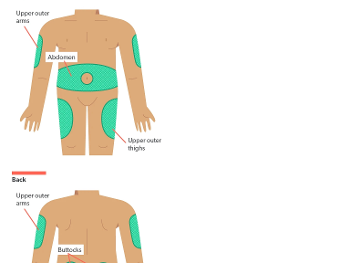 Subcutaneous injections 