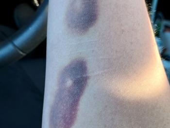 Photo of a forearm with two significant bruises 