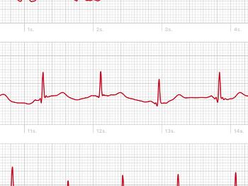 Screenshot of ecg trace