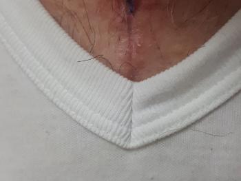 Suture protruding through open chest wound