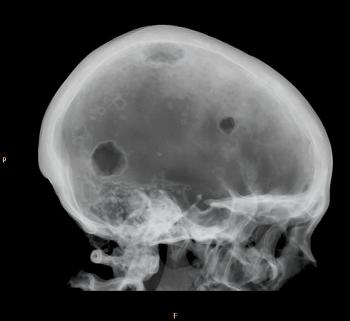 skull metastasis image from internet