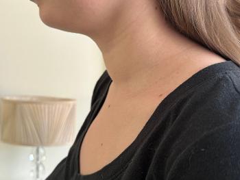 Swollen neck 