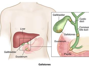 Gallstones blocking the bile duct.