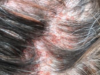 Brown spots on scalp