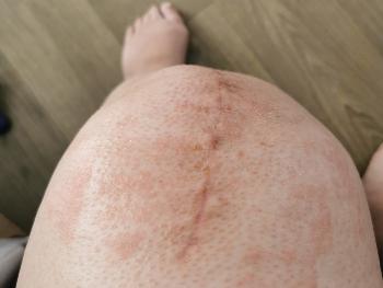 Tiny blisters over knee and surrounding area
