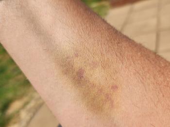 Bruise on arm