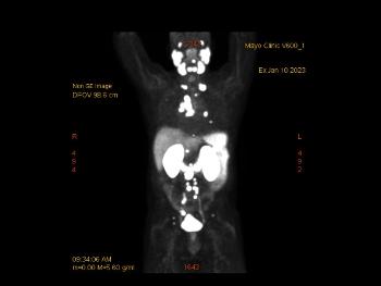January 2023 PSMA Pet scan, prior to treatment.