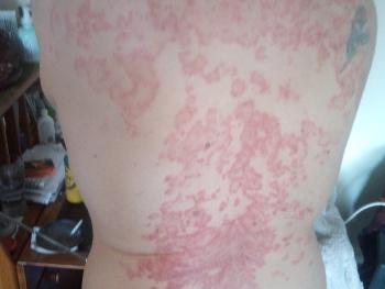 My back rash