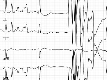 Interference in ecg trace