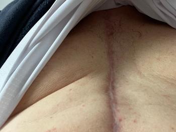 Chest incision 