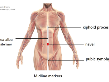 pubic symphysis, navel, xiphoid process on midline linea alba between rectus abdominis