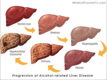 Progression of alcohol related liver disease.