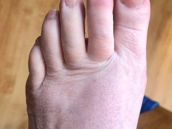 Foot with Raynaud’s 