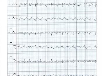 Sample Kardia EKG