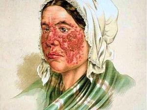 From Wikipedia: lupus erythematosus in the 20th century.