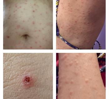 Some photos of my rash