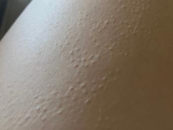 Patches of “goosebumps” on thigh