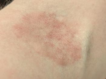 Forearm rash flared like hives but doesn't go away leave red patch 6 months +