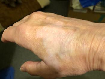 A hand with vitiligo
