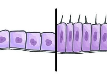 Cells changing from one to another -Metaplasia. 