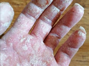 Colour photo of hand and fingers covered with severe contact dermatitis 