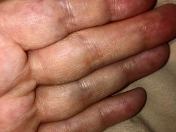 Photo of matted telengecstasia on fingers 